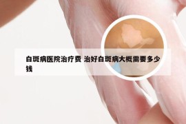 白斑病医院治疗费 治好白斑病大概需要多少钱