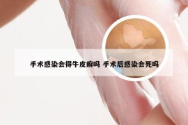 手术感染会得牛皮癣吗 手术后感染会死吗