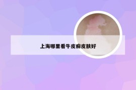 上海哪里看牛皮癣皮肤好