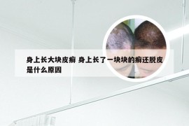 身上长大块皮癣 身上长了一块块的癣还脱皮是什么原因