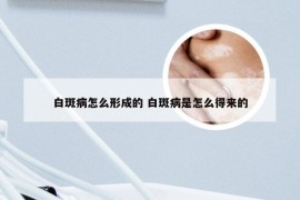 白斑病怎么形成的 白斑病是怎么得来的