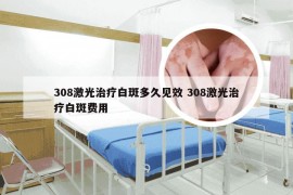 308激光治疗白斑多久见效 308激光治疗白斑费用