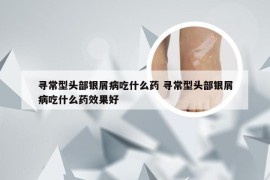 寻常型头部银屑病吃什么药 寻常型头部银屑病吃什么药效果好