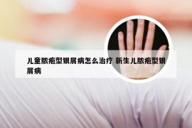 儿童脓疱型银屑病怎么治疗 新生儿脓疱型银屑病