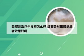 益赛普治疗牛皮癣怎么样 益赛普对银屑病患者效果好吗