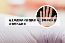 身上不规律的长椭圆状癣 身上不规律的长椭圆状癣怎么回事