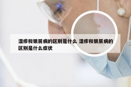 湿疹和银屑病的区别是什么 湿疹和银屑病的区别是什么症状