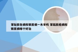 掌趾脓包病和银屑病一木羊吗 掌跖脓疱病和银屑病哪个好治