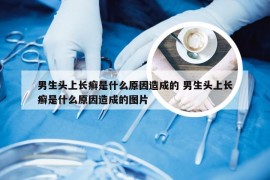 男生头上长癣是什么原因造成的 男生头上长癣是什么原因造成的图片