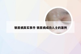 银屑病真实事件 银屑病成功人士的案例