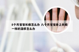 8个月宝宝长癣怎么办 八个月宝宝身上长癣一样的湿疹怎么办