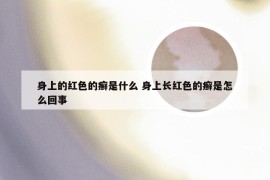 身上的红色的癣是什么 身上长红色的癣是怎么回事