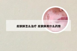 皮肤鲜怎么治疗 皮肤鲜用什么药擦