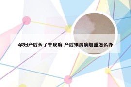 孕妇产后长了牛皮癣 产后银屑病加重怎么办