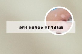 急性牛皮癣传染么 急性牛皮肤癣