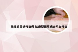 脓性银屑病传染吗 脓疱型银屑病会不会传染