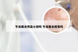 牛皮廨会传染小孩吗 牛皮廨会癌变吗