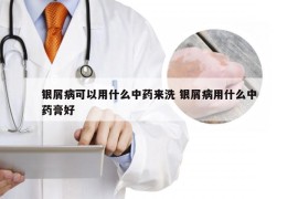 银屑病可以用什么中药来洗 银屑病用什么中药膏好