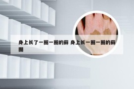 身上长了一圈一圈的藓 身上长一圈一圈的藓图