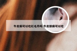 牛皮癣可以吃红毛丹吗 牛皮肤癣可以吃