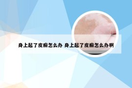 身上起了皮癣怎么办 身上起了皮癣怎么办啊