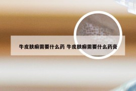 牛皮肤癣需要什么药 牛皮肤癣需要什么药膏