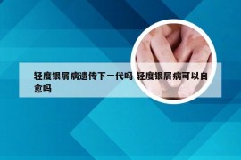 轻度银屑病遗传下一代吗 轻度银屑病可以自愈吗