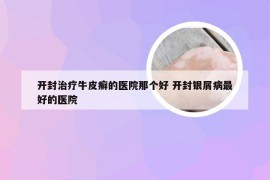 开封治疗牛皮癣的医院那个好 开封银屑病最好的医院