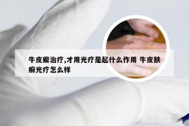 牛皮廨治疗,才用光疗是起什么作用 牛皮肤癣光疗怎么样