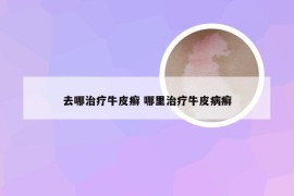 去哪治疗牛皮癣 哪里治疗牛皮病癣