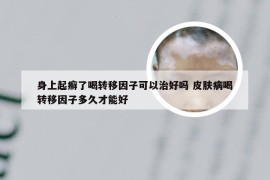 身上起癣了喝转移因子可以治好吗 皮肤病喝转移因子多久才能好