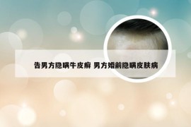 告男方隐瞒牛皮癣 男方婚前隐瞒皮肤病