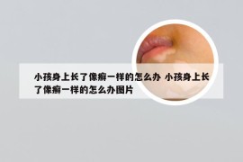 小孩身上长了像癣一样的怎么办 小孩身上长了像癣一样的怎么办图片