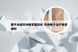 看牛皮癣苏州哪家医院好 苏州哪个治疗银屑病好