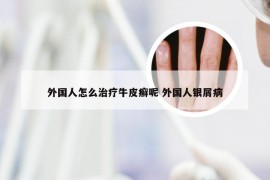 外国人怎么治疗牛皮癣呢 外国人银屑病