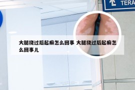 大腿挠过后起癣怎么回事 大腿挠过后起癣怎么回事儿