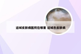 运城皮肤病医院在哪里 运城市皮肤病