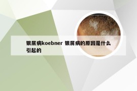 银屑病koebner 银屑病的原因是什么引起的