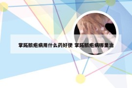 掌跖脓疱病用什么药好使 掌跖脓疱病哪里治