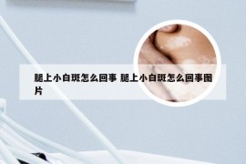 腿上小白斑怎么回事 腿上小白斑怎么回事图片