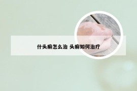 什头癣怎么治 头癣如何治疗