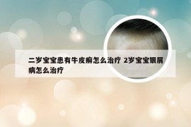 二岁宝宝患有牛皮癣怎么治疗 2岁宝宝银屑病怎么治疗