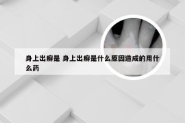 身上出癣是 身上出癣是什么原因造成的用什么药