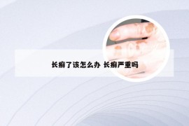 长癣了该怎么办 长癣严重吗