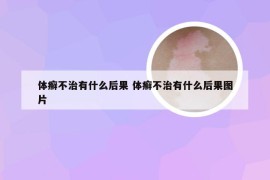 体癣不治有什么后果 体癣不治有什么后果图片