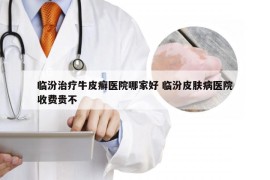 临汾治疗牛皮癣医院哪家好 临汾皮肤病医院收费贵不