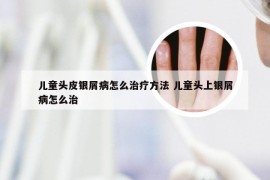 儿童头皮银屑病怎么治疗方法 儿童头上银屑病怎么治