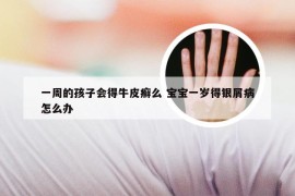 一周的孩子会得牛皮癣么 宝宝一岁得银屑病怎么办