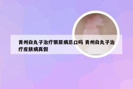 青州白丸子治疗银屑病忌口吗 青州白丸子治疗皮肤病真假