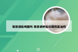 银屑病能喝醋吗 银屑病啊能吃醋和酱油吗